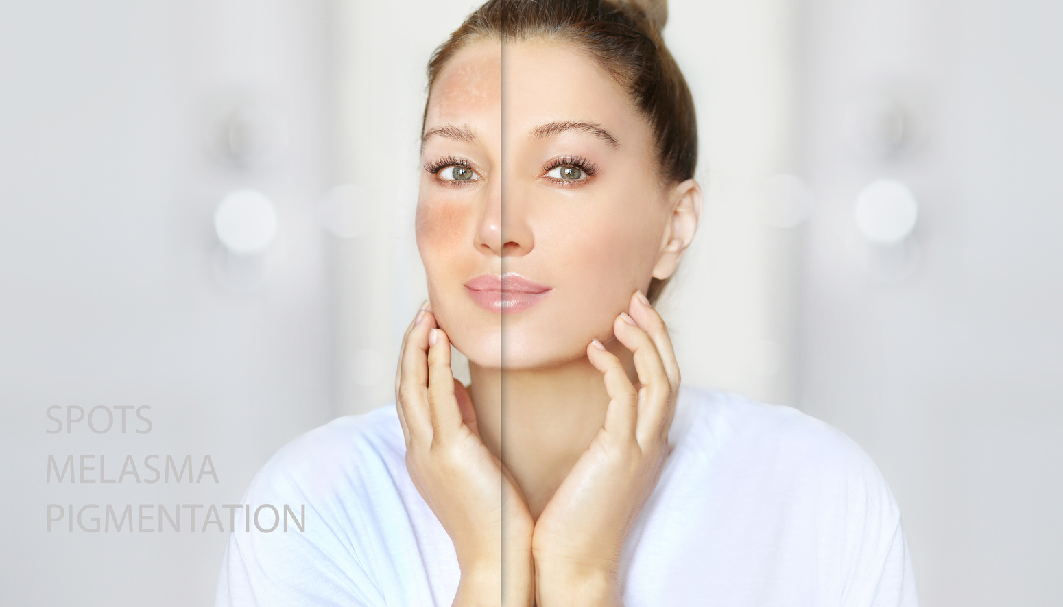 Dark spots, freckles,hyperpigmentation(melasma or chloasma),concept- skin lightening, skin whitening, Skin Brightening